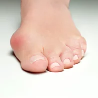 Hallux Valgus - vybočený palec