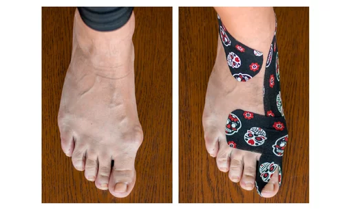 vybočený palec, hallux, tejping halluxu vybočený palec, hallux, tejping halluxu